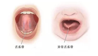 舌头探洞水好多怎么办？舌头探洞原因、处置方法及预防措施解析与建议